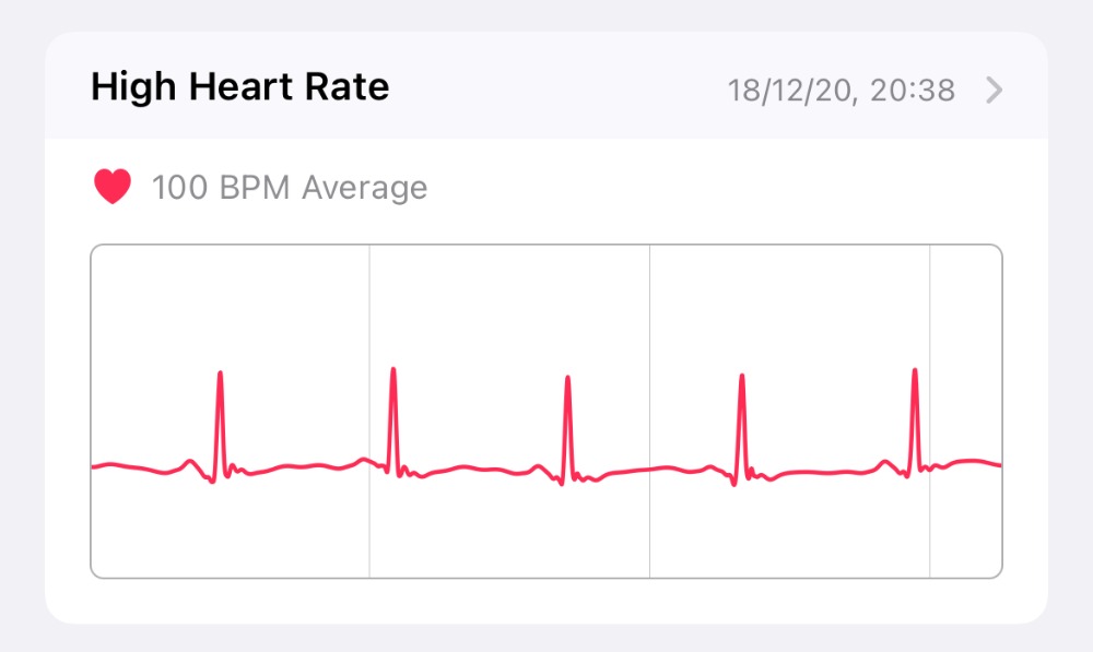 High Heart Rate at Rest