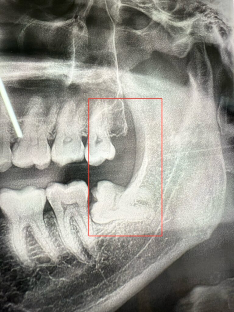 Impacted Third Molar of the Lower Jaw