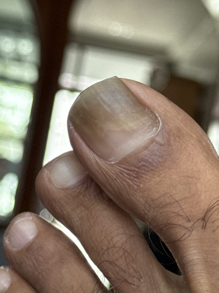 Onycholysis Toe nail discolouration