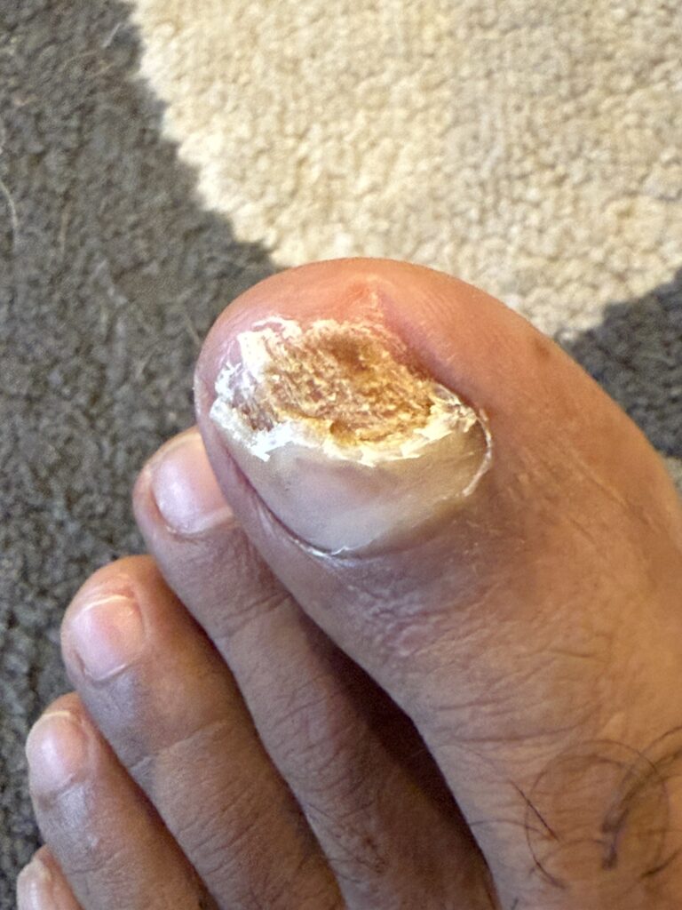Partially exposed nail bed with Onycholysis immediately after partial removal of toenail