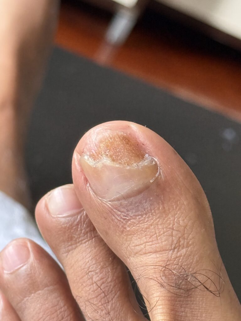 Toenail recovery Day 2 (Coverage:80%-30%)