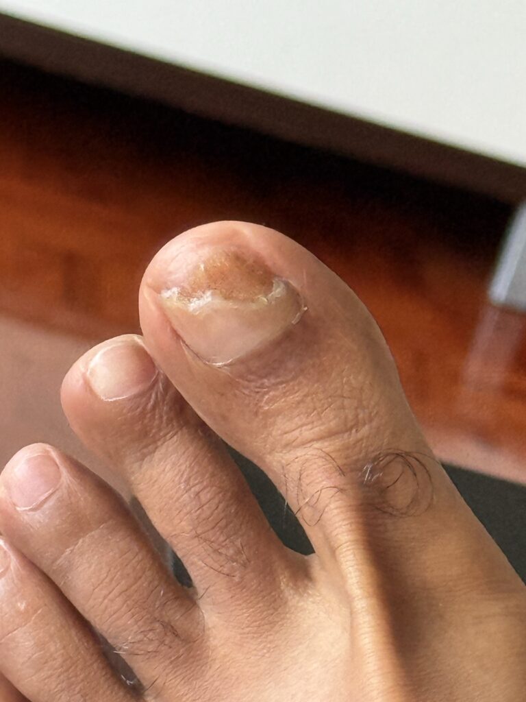 Toenail recovery Day 4 (Coverage:80%-30%)