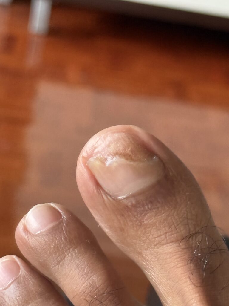 Toenail recovery Day 7 (Coverage:80%-30%)