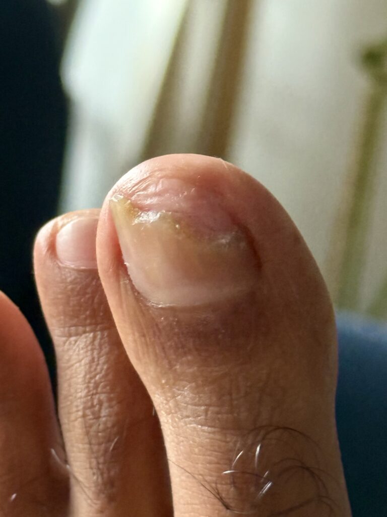 Toenail recovery 1 Month (Coverage:90%-40%)