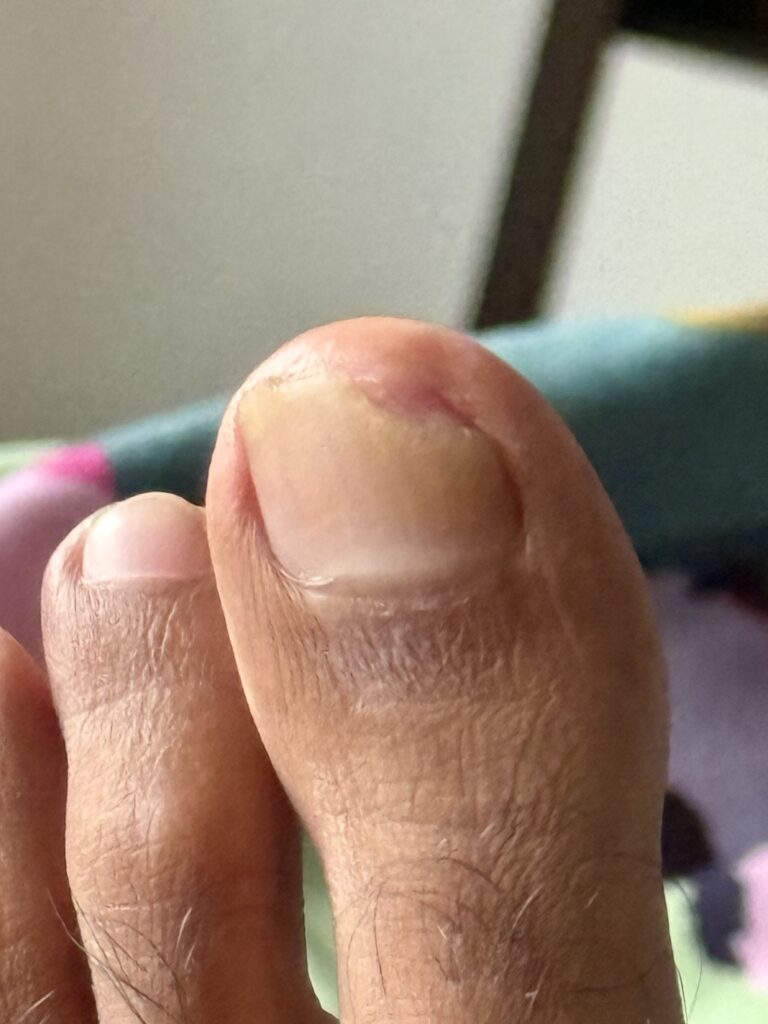 Toenail recovery at 2 Months