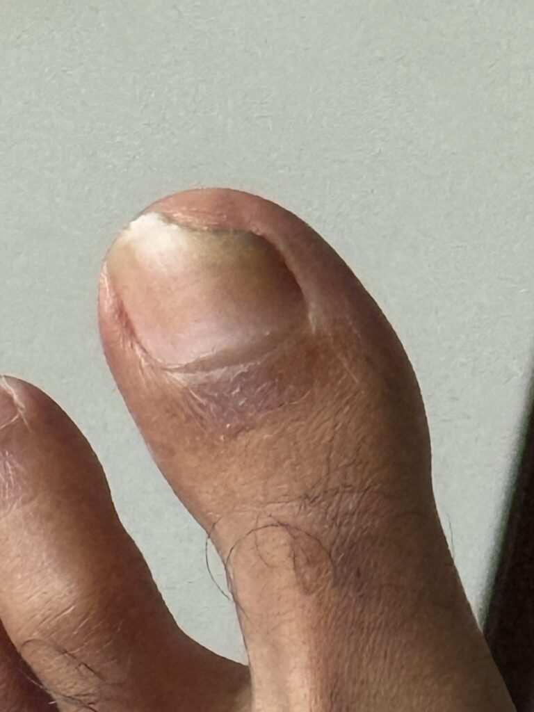 Toenail recovery at 3 Months