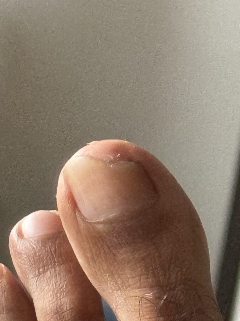 Toenail recovery at 4 Months