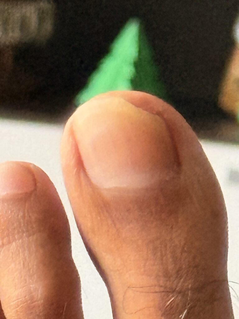 Toenail recovery at 6 Months