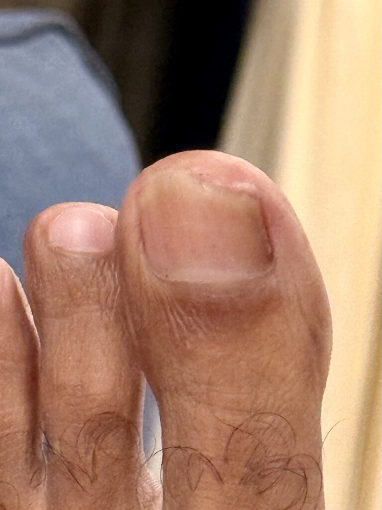 Toenail recovery at 5 Months