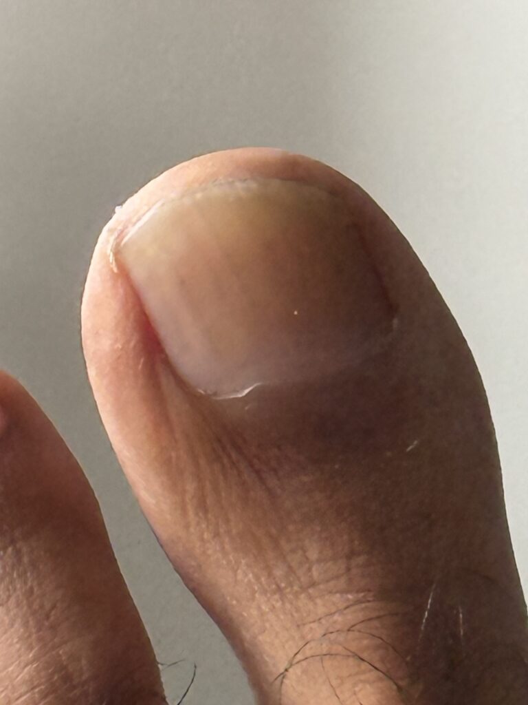 Toenail recovery at 7 Months