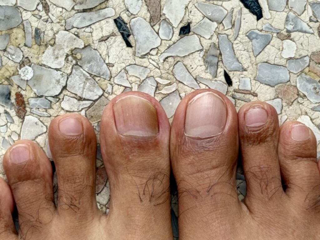 Left foot toenail different colour now